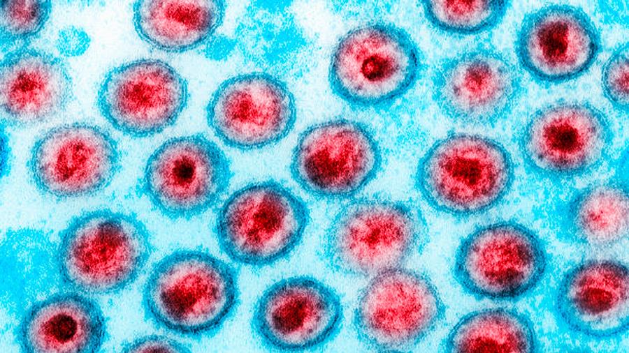 Stevige virologische respons op klassieke antiretrovirale middelen in geval van hiv-infectie ondanks PrEP met injecties van CAB-LA