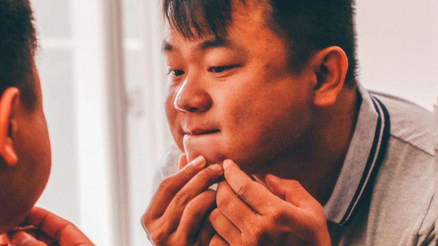 Septembre, le mois de l’acné ?